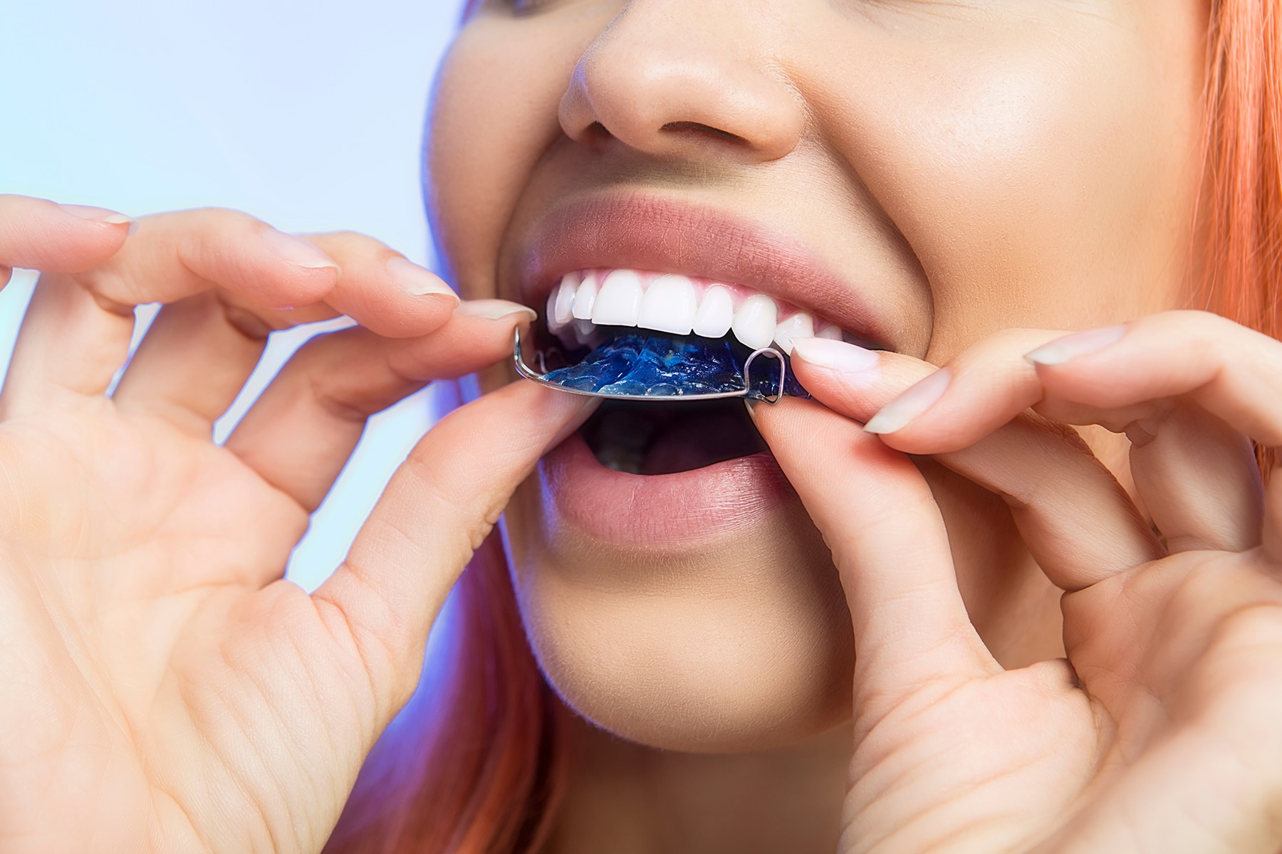 Orthodontic retainers in Castle Rock, CO