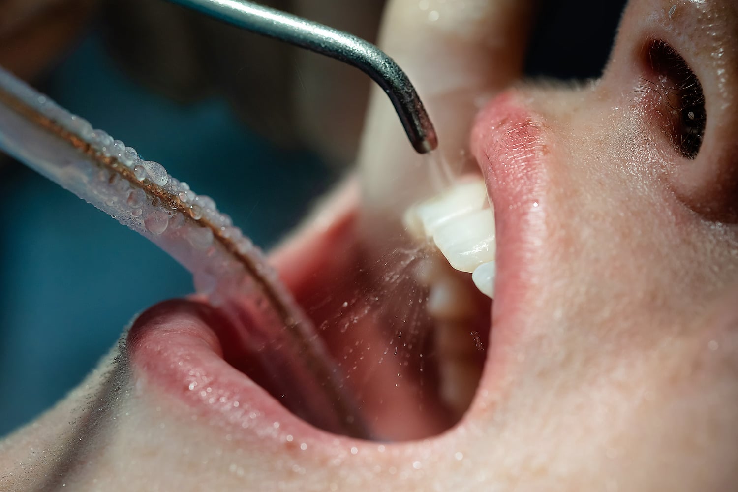 Person recieves a deep dental cleaning in Castle Rock CO