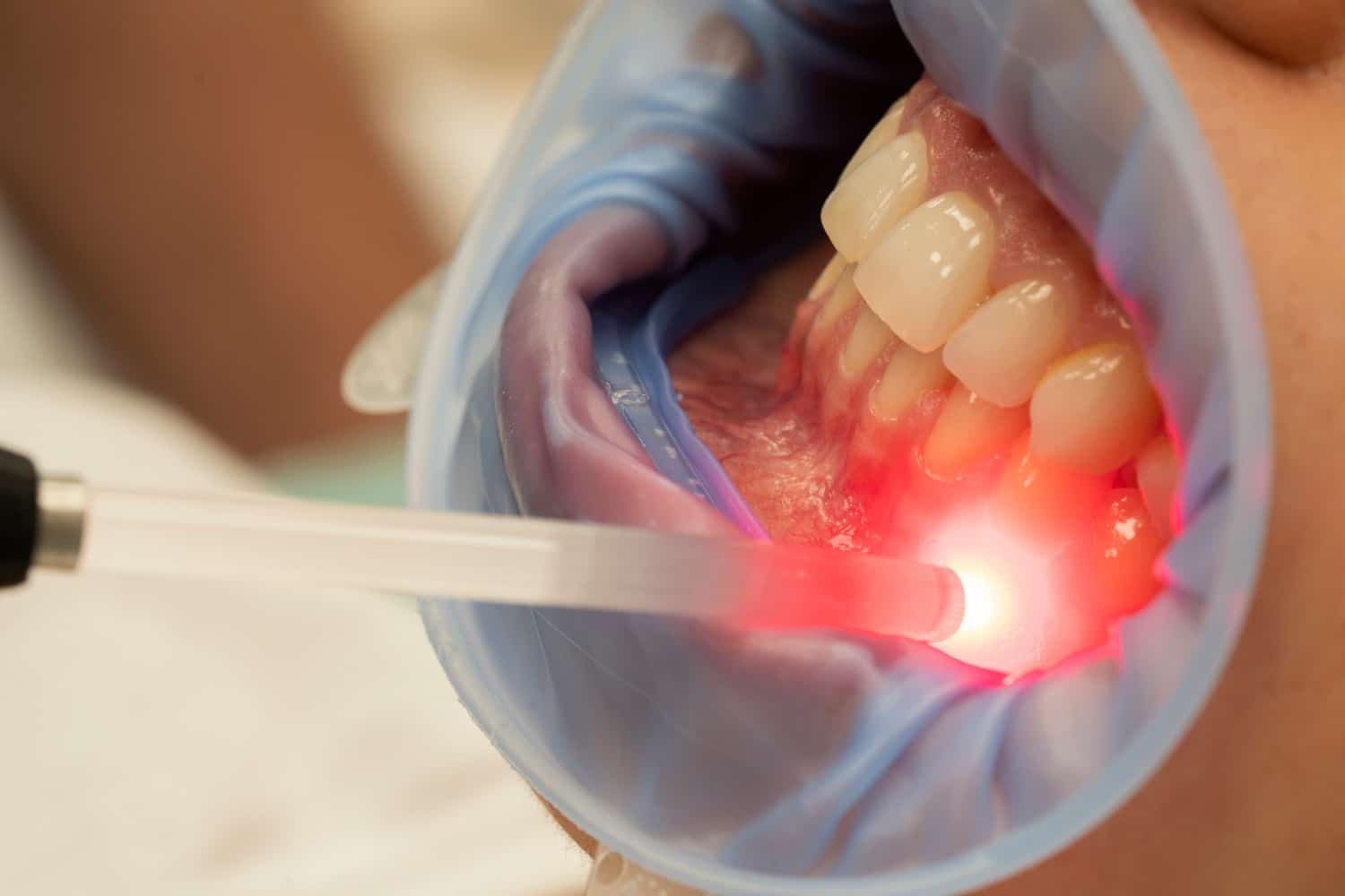 Patient recieves laser therapy on their gum to improve pain in Castle Pines CO